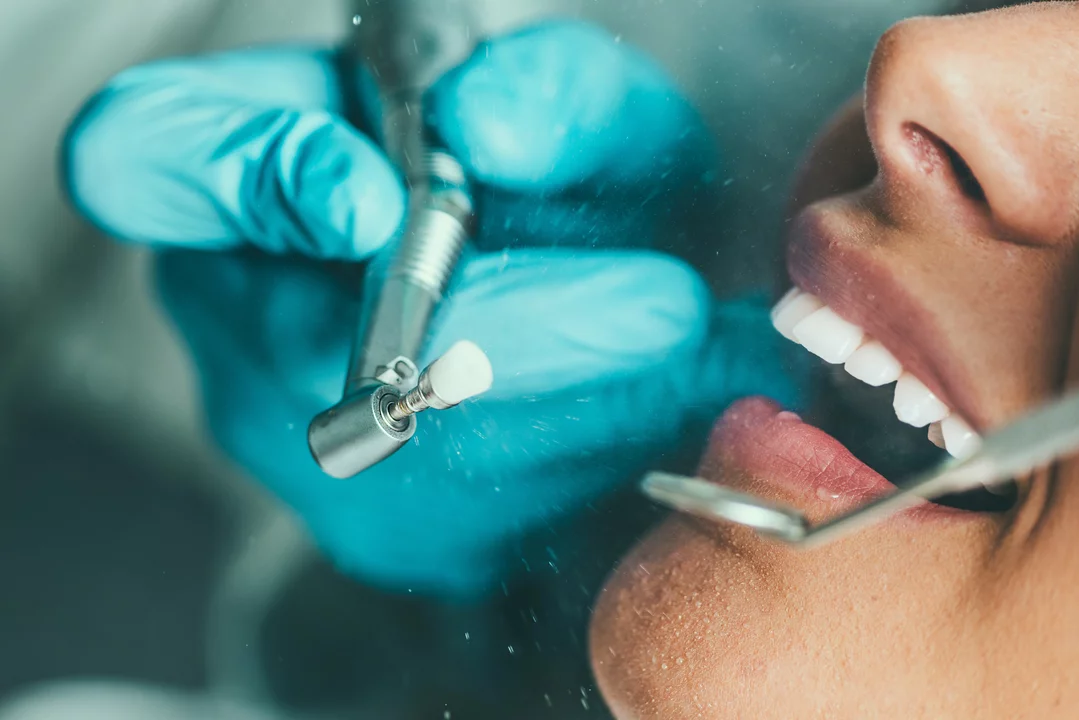 The Role of Prophylaxis in Preventing Tooth Erosion
